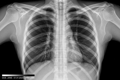 How Do Lung Supplements Assist in Recovery from Respiratory Infections?
